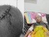 Berjuang Melawan Tumor Otak, Reki Menanti Uluran Tangan Para Dermawan
