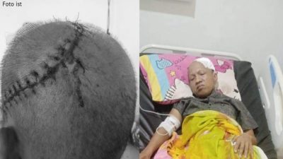 Berjuang Melawan Tumor Otak, Reki Menanti Uluran Tangan Para Dermawan