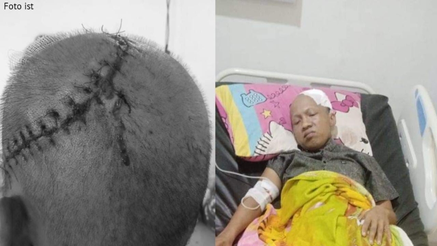 Berjuang Melawan Tumor Otak, Reki Menanti Uluran Tangan Para Dermawan