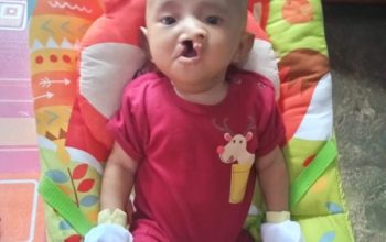 Balita Penderita Bibir Sumbing di Tubaba Berharap Bantuan Dermawan dan Pemerintah