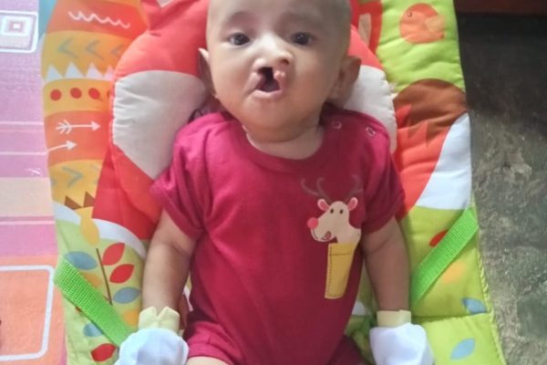 Balita Penderita Bibir Sumbing di Tubaba Berharap Bantuan Dermawan dan Pemerintah